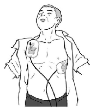 パッドを胸の右上と左脇に貼り付けているイラスト