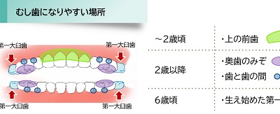 むし歯になりやすい場所